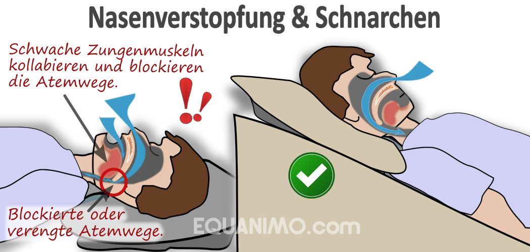 EZsleep Bettkeil fördert bessere Atmung, daher hilft es bei Nasenverstopfung und Schnarchen
